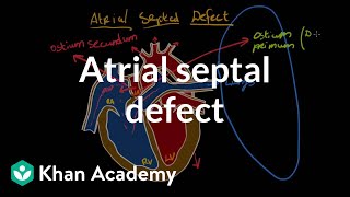 Understanding Atrioventricular AV Septal Defect [upl. by Heidy957]