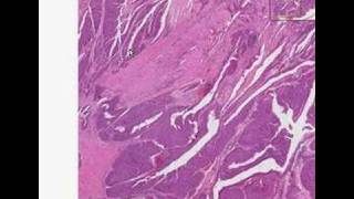 Histopathology KidneyTransitional cell carcinoma [upl. by Naoj507]