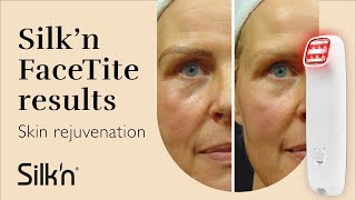 Silkn FaceTite  Skin rejuvenation  Before and After [upl. by Oinolopa]