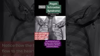 Cool visualization of Thoracic Outlet Syndrome [upl. by Curt]