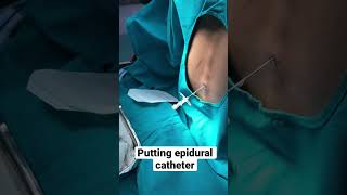 Putting a epidural catheter mbbs anesthesia [upl. by Porche]