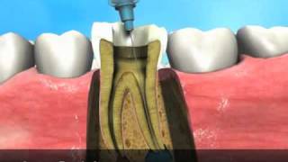 Endodontia  Processo Periapical [upl. by Elleval]