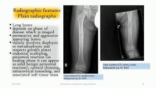 LangerhansCell Histiocytosis of the bone  ‘‘The great mimmicker’’ [upl. by Nangatrad200]