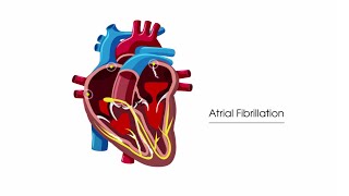 What is atrial fibrillation [upl. by Worl]