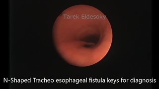 N shaped tracheoesophageal fistula Keys for diagnosis [upl. by Beltran]