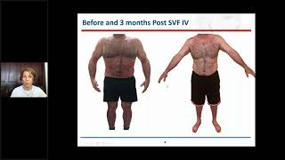 Intravenous implantation of stromal vascular fraction in psoriasis  Video abstract ID 163612 [upl. by Kazmirci]