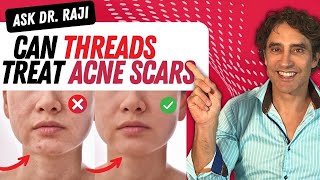 TREATING SCARS With PDO THREADS  Scar Removal [upl. by Ecirpac]