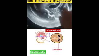 Colpocephaly  Ultrasound Brain Radiology [upl. by Meng378]