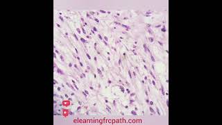 softtissue spindlecell liposarcoma dedifferentiated frcpathpart2 elearningfrcpathcom [upl. by Haywood]