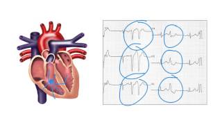 Echogenic intracardiac focus in left ventricle in level 2nd [upl. by Sheena539]