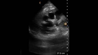 Severe Hydronephrosis  Ultrasound Image Interpretation [upl. by Miriam]