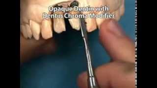 Integrated Abutment Crown™ Laboratory Technique [upl. by Giralda]