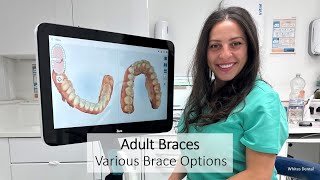 Adult Braces  Various Brace Options  London  Whites Dental [upl. by Aiciled603]