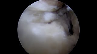 Labral Partial Detachment with Surrounding Grade 2 Articular Cartilage Injury [upl. by Yerfej]