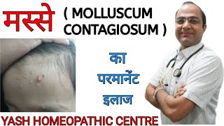 Molluscum contagiosum  warts face  चेहरे के मस्से का इलाज [upl. by Atterahs325]