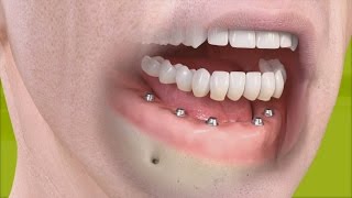 Straumann  Fixed restoration with 46 implants all straight [upl. by Enaek]