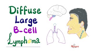 Diffuse Large BCell Lymphoma DLBCL  Aggressive BCell Neoplasm  NonHodgkin’s Lymphoma [upl. by Haraz]