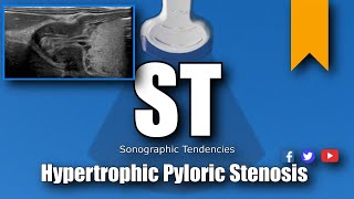 Pyloric Ultrasound [upl. by Ise]