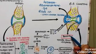 Rheumatoid arthritis aetiology pathophysiology symptoms and treatment in hindi [upl. by Elvin]