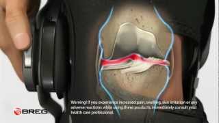 Learn About Knee Osteoarthritis OA [upl. by Ahsinnod]