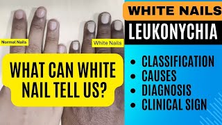 White Nails Leukonychia  Classification Causes Diagnosis  Nail Changes in Systemic Diseases [upl. by Idnahs]