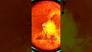 Diabetic retinopathy  Hemorrhages  Hard exudates  Fundus  Short Video 191 [upl. by Emmerie]