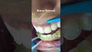 Braces off  complete Removal of Braces [upl. by Hasan]