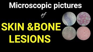 Oral pathologyMicroscopic histology pictures of boneamp skin lesions in oral region Dr Poojireddy [upl. by Filip]