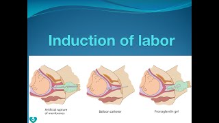 Induction of labor [upl. by Alisha61]