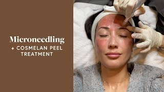 Microneedling Treatment amp Cosmelan Peel For My Melasma  Susan Yara [upl. by Annez]