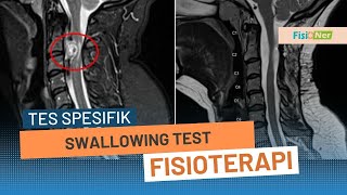 Swallowing Test  Indikasi Adanya Tumor Atau gangguan Lain di Leher [upl. by Gabbi]