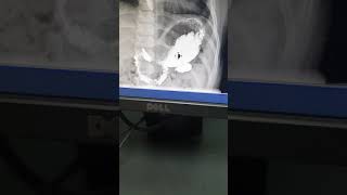 Serie Esófago Gastro Duodenal SEGD en Niños [upl. by Hamaso]