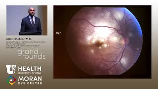 Uveitis Presentations [upl. by Fry]