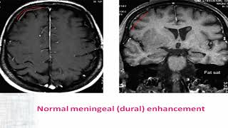 04 IBIC Supratentorial Extraaxial lesions Part02 [upl. by Rahs]