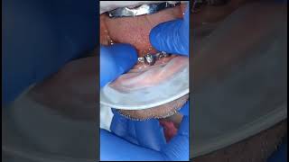 Lower full arch basal implants splinting with milled titanium bar [upl. by Burkhard]