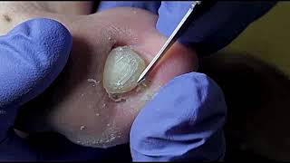 DIY Ingrown Toenail Removal  How to Safely Cut Ingrown Toenails at Home [upl. by Ricardama]