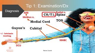 10 TIPS in dealing with Cubital Tunnel Syndrome [upl. by Assiram]