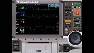 Capnography Waveform with ROSC [upl. by Anidualc784]