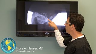 Cause of occipital neuralgia and migraines seen on DMX and resolved with Prolotherapy [upl. by Darci]