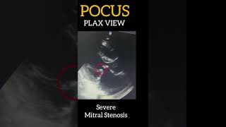 POCUS  Severe Mitral Stenosis  2D ECHO  PLAX View [upl. by Yattirb]