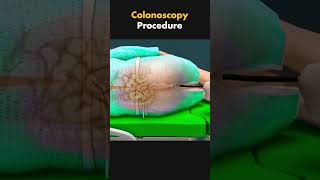 Colonoscopy procedure ⁉️ 3D animation of colonoscopy proneetmcqbiologyexamfacts biologyquiz [upl. by Aitsirt602]