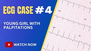 ECG Case 4 A Young Girl having Palpitations  EKG Explained [upl. by Otreblaug]