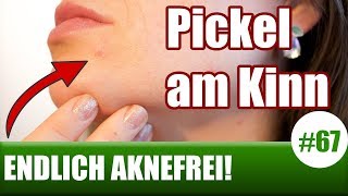 Pickel am Kinn loswerdenHormonelle Hautprobleme  FacemappingGesichtskarte ENDLICH AKNEFREI 67 [upl. by Drescher]