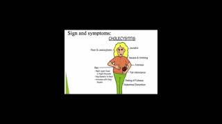 Cholecystitis digestive system disorder [upl. by Lund]