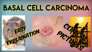 BASAL CELL CARCINOMA  RODENT ULCER   PART 2 [upl. by Lisabet]