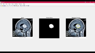 Brain Tumor Detection using Matlab  Image Processing  GUI step by step [upl. by Sandra163]