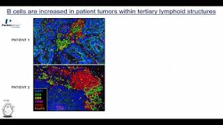 Deciphering the function of B cells in human cancer [upl. by Armanda]