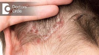 Treatment options for Scalp Psoriasis  Dr Rashmi Ravindra [upl. by Cam]