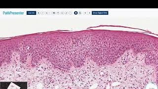 SPONGIOTIC DERMATITIS [upl. by Giesecke861]