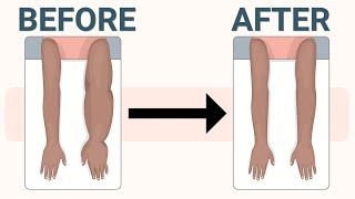 Treatment for Arm Lymphedema and Swelling after Cancer Surgery [upl. by Aihsei]